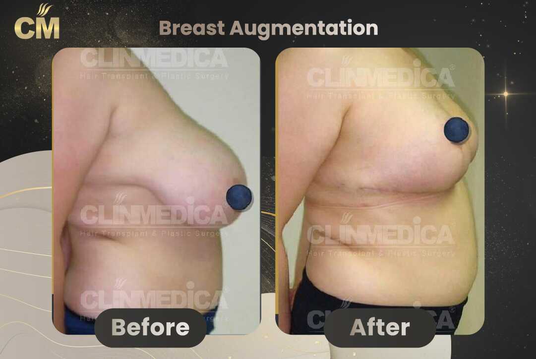 Breast Augmentation with Lift Before and After in Turkey