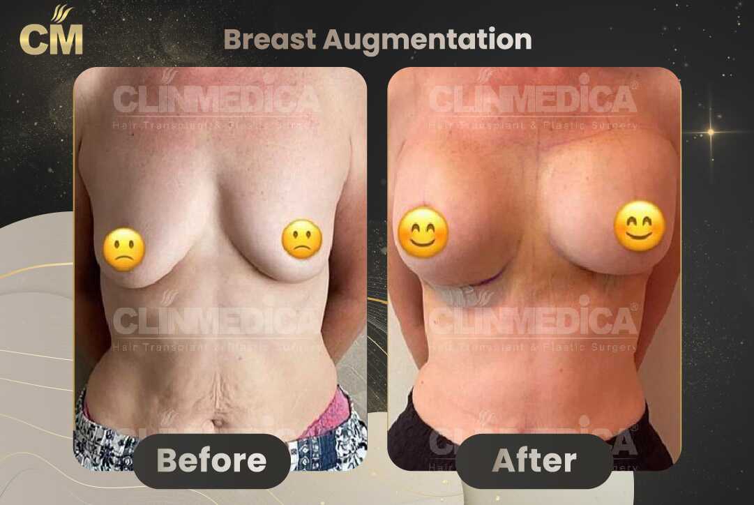 Breast Augmentation Before and After in Turkey