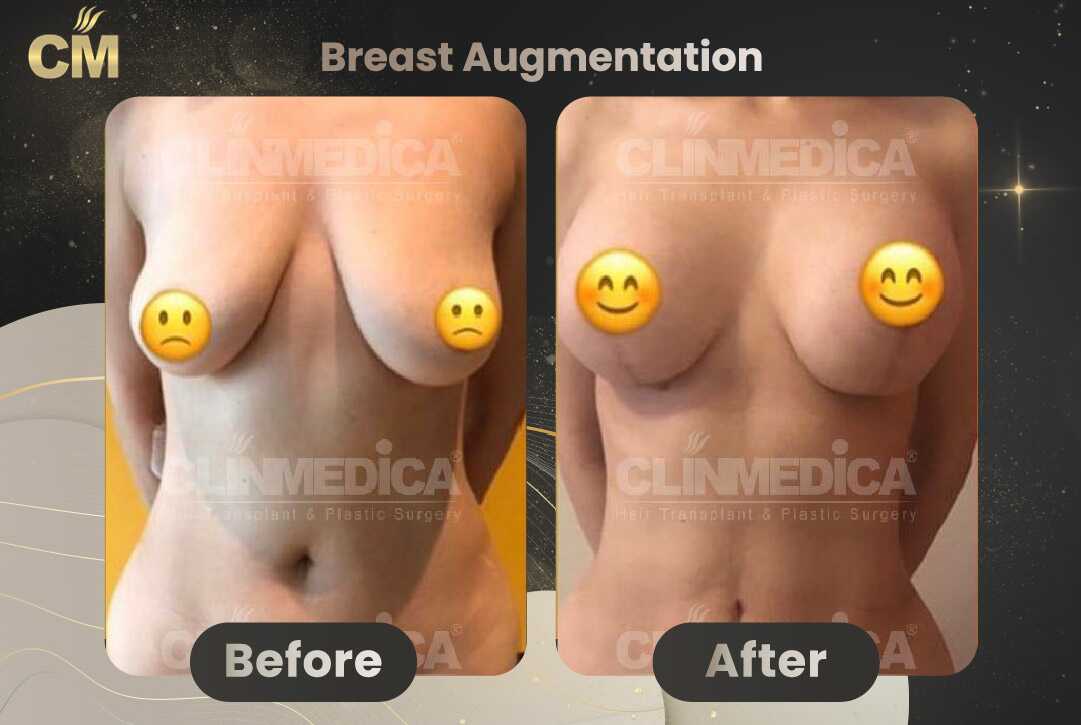 Breast Augmentation with Lift Before and After in Turkey