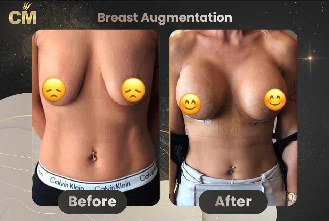 Breast Augmentation with Lift Before and After in Turkey