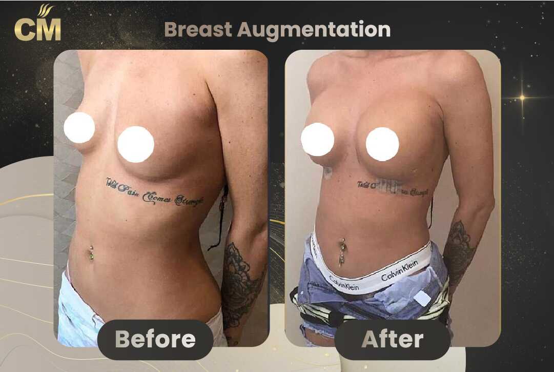 Breast Augmentation with Lift Before and After in Turkey