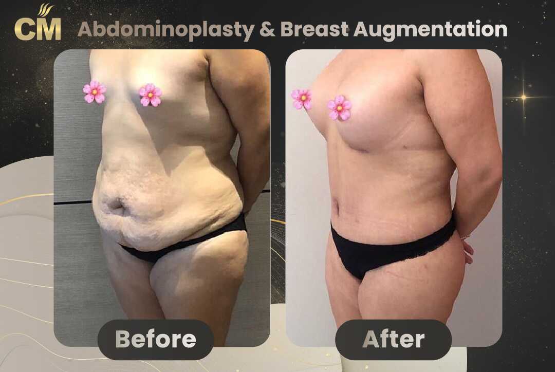 Tummy Tuck (Abdominoplasty) Before and After in Turkey