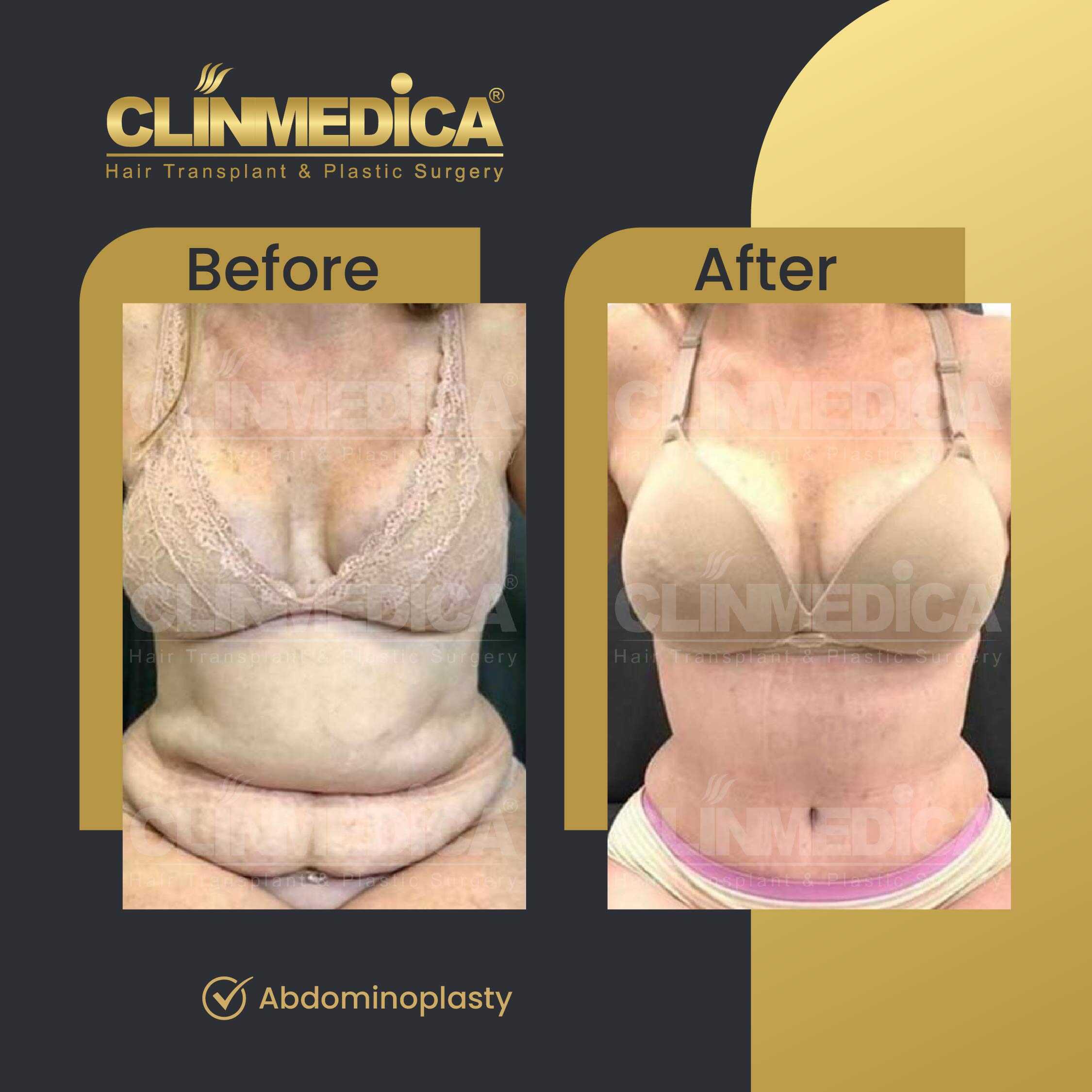 Tummy Tuck (Abdominoplasty) Before and After in Turkey