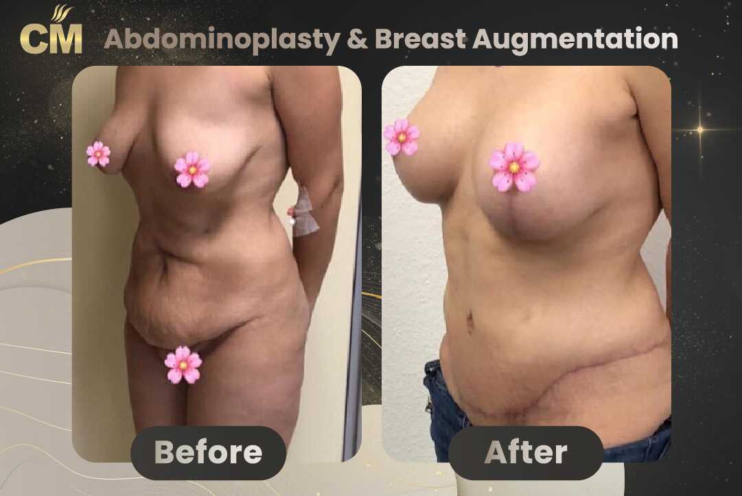 Tummy Tuck (Abdominoplasty) Before and After in Turkey