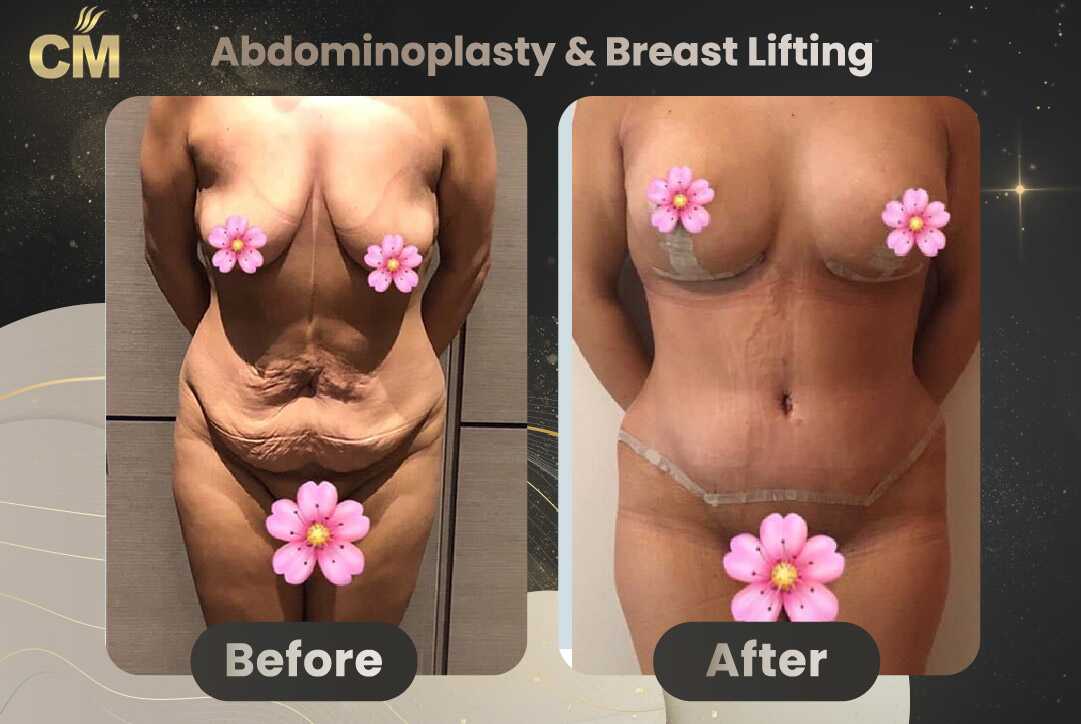 Tummy Tuck (Abdominoplasty) Before and After in Turkey