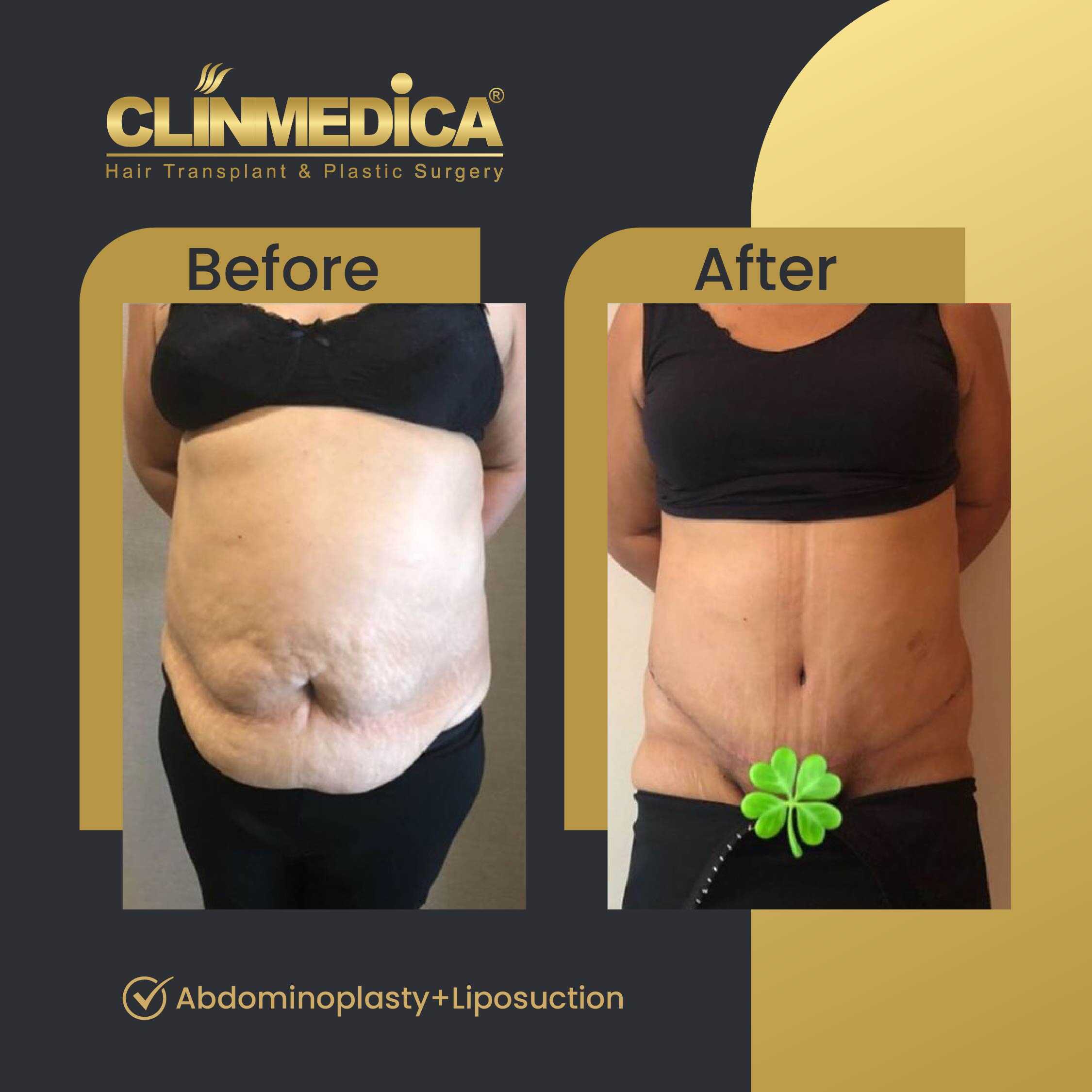 Tummy Tuck (Abdominoplasty) Before and After in Turkey