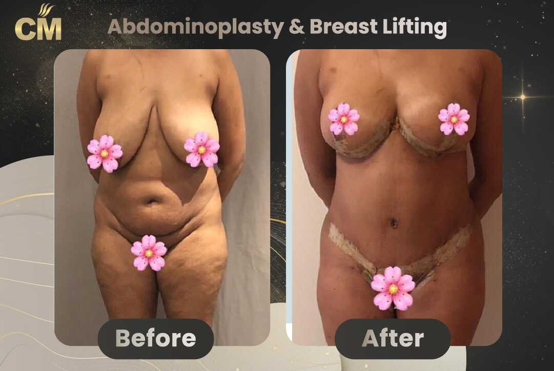 Tummy Tuck (Abdominoplasty) Before and After in Turkey