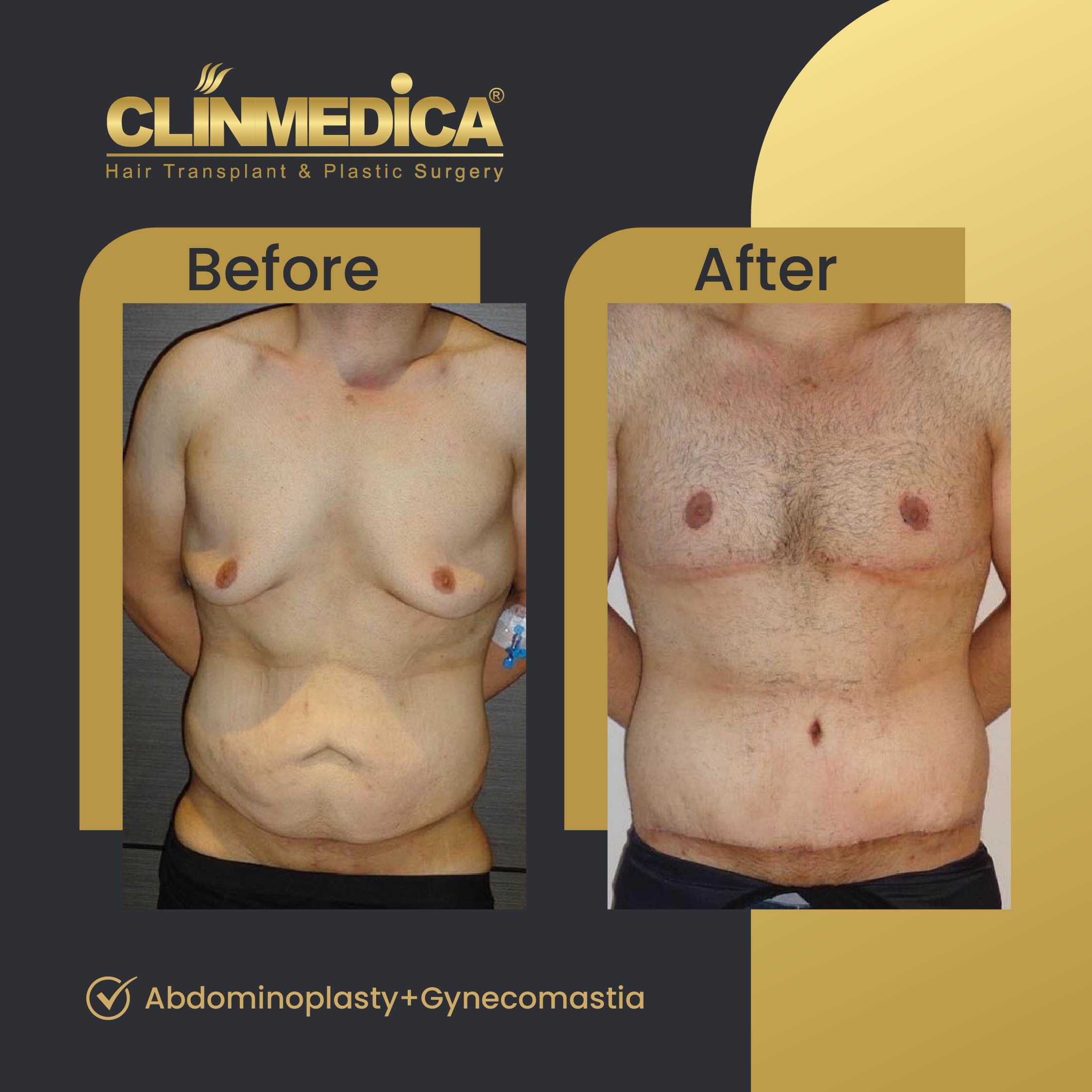 Tummy Tuck (Abdominoplasty) Before and After in Turkey