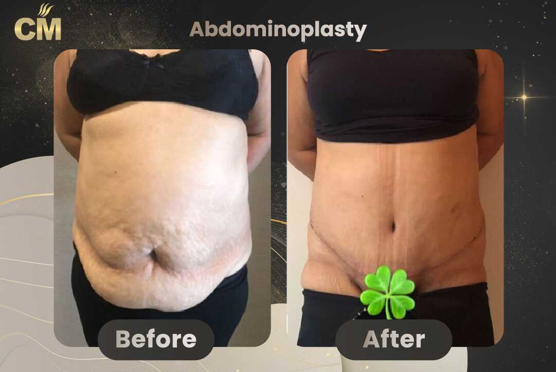 Tummy Tuck (Abdominoplasty) Before and After in Turkey