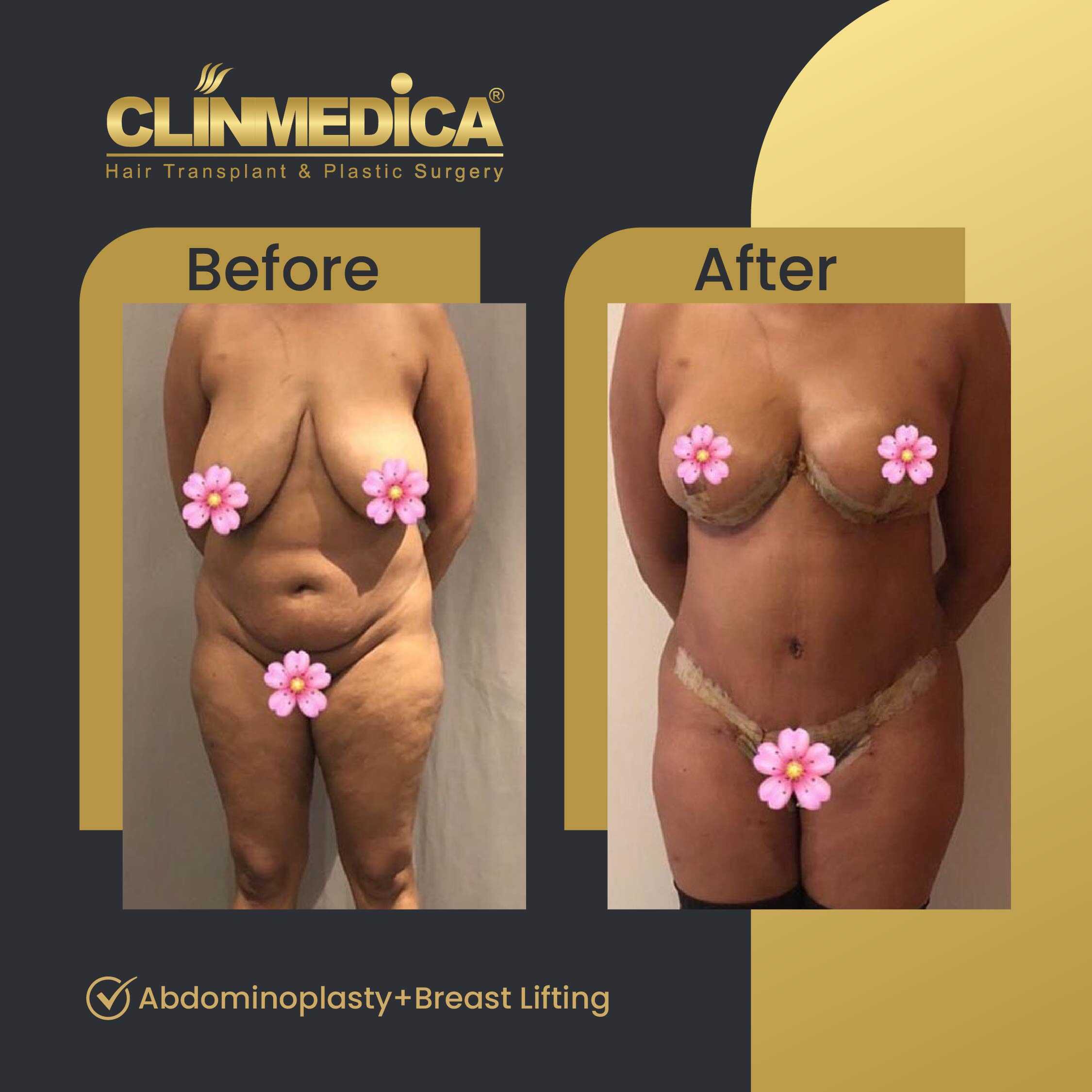 Tummy Tuck (Abdominoplasty) Before and After in Turkey