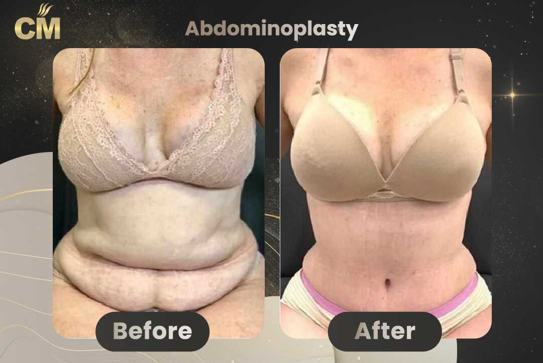 Tummy Tuck (Abdominoplasty) Before and After in Turkey