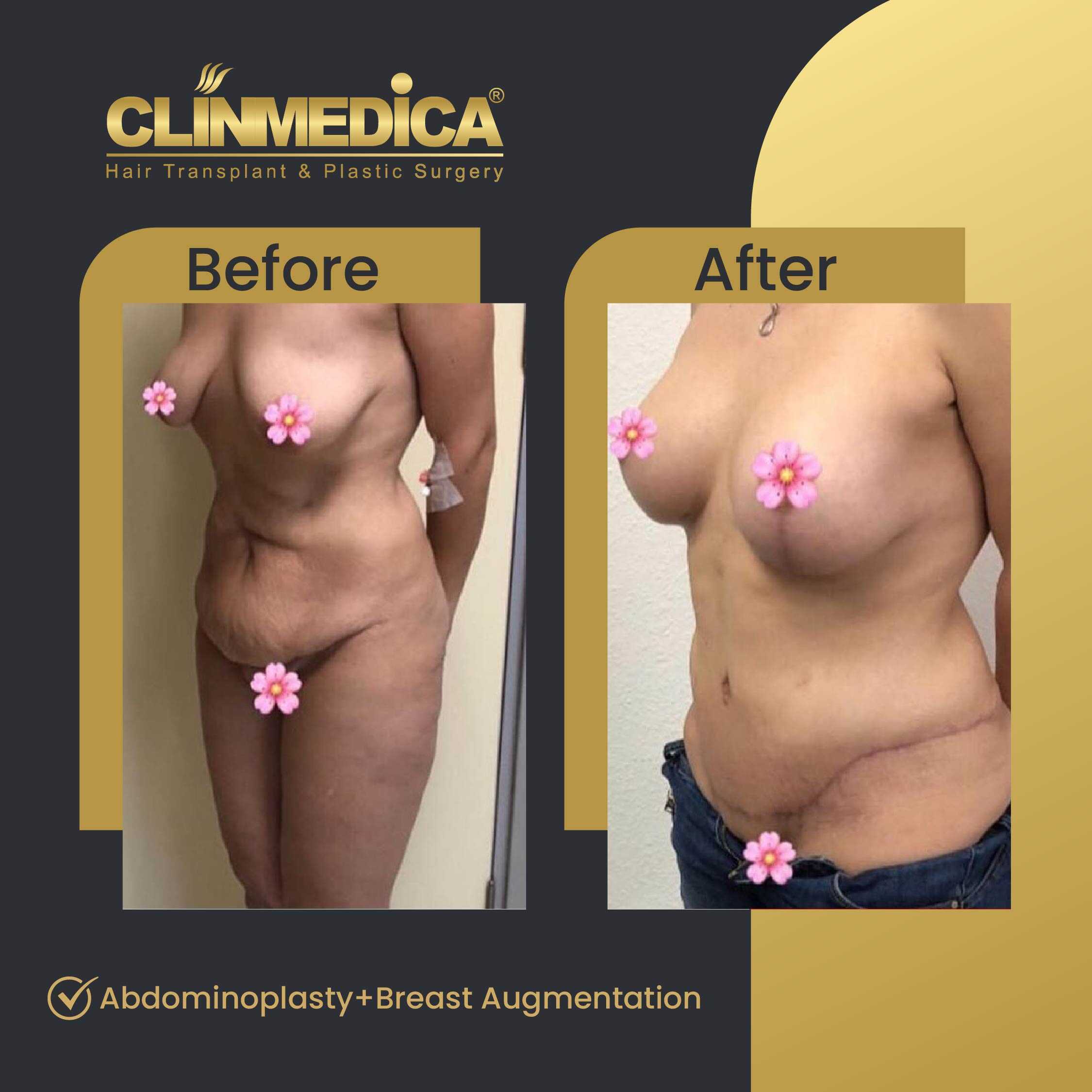 Tummy Tuck (Abdominoplasty) Before and After in Turkey