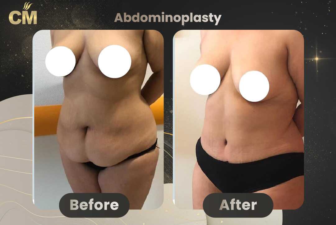 Tummy Tuck (Abdominoplasty) Before and After in Turkey