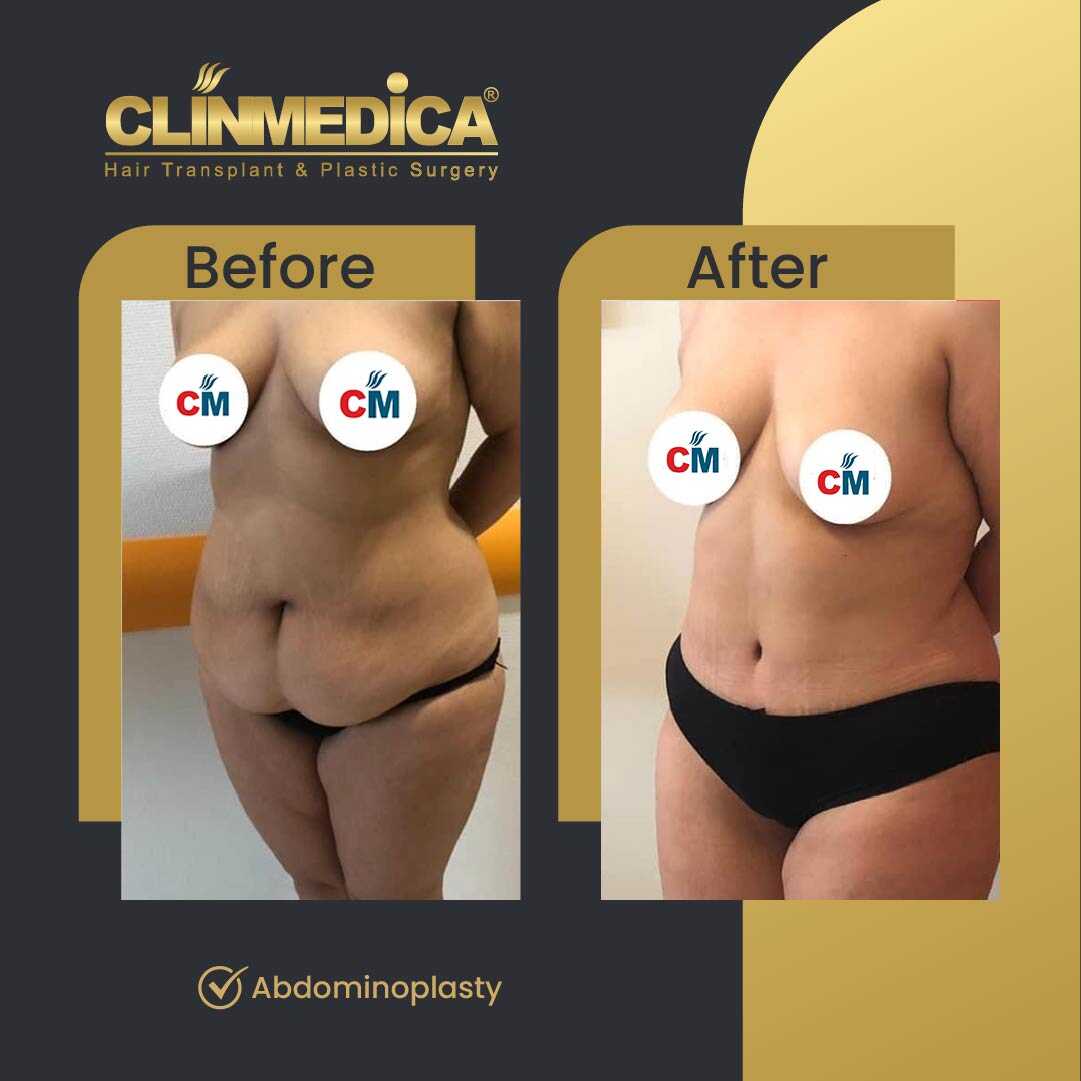 Tummy Tuck (Abdominoplasty) Before and After in Turkey