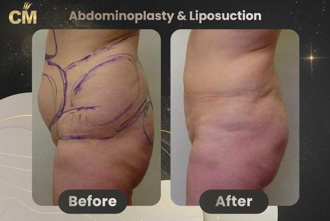 Tummy Tuck (Abdominoplasty) Before and After in Turkey