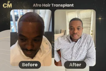 Afro Hair Transplant Before and After in Turkey