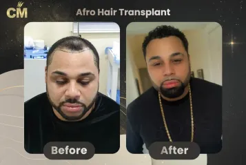 Afro Hair Transplant Before and After in Turkey