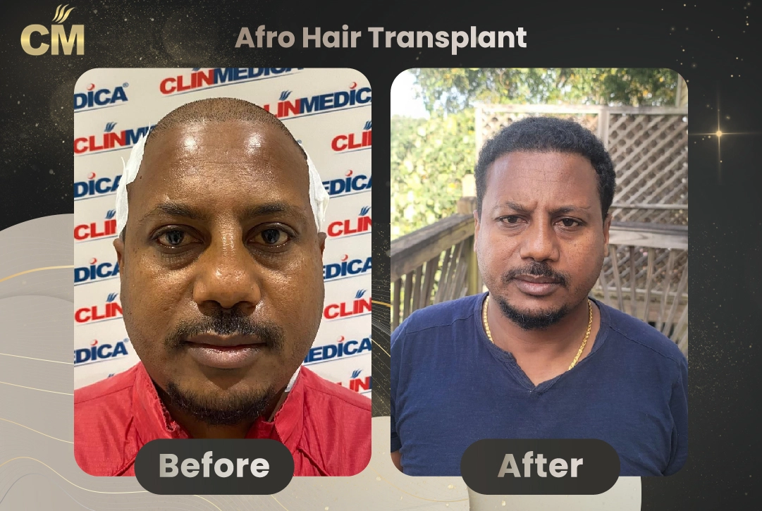 Afro Hair Transplant Before and After in Turkey