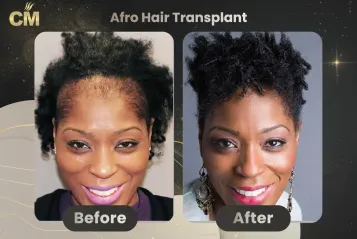 Afro Hair Transplant Before and After in Turkey