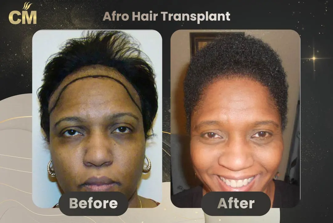 Afro Hair Transplant Before and After in Turkey