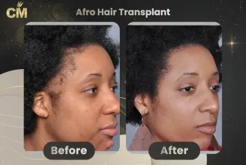 Afro Hair Transplant Before and After in Turkey