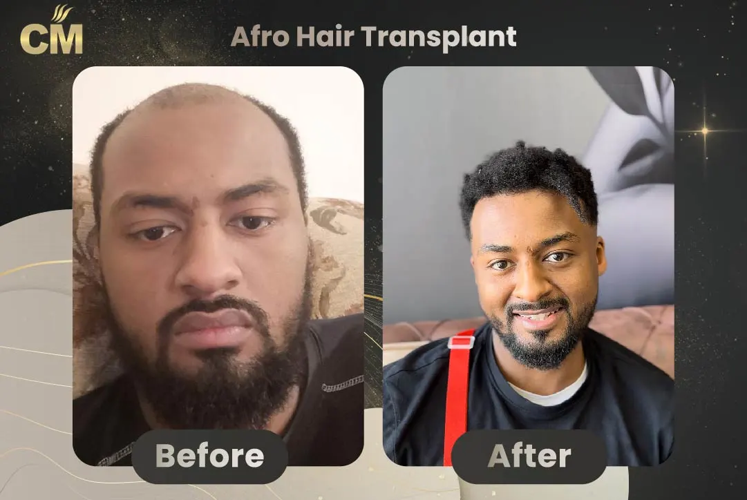 Afro Hair Transplant Before and After in Turkey