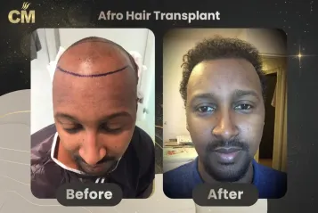 Afro Hair Transplant Before and After in Turkey