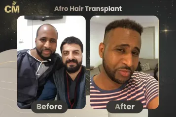 Afro Hair Transplant Before and After in Turkey