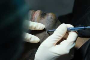 beard transplant in Turkey