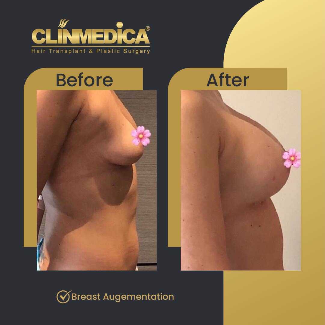 Breast Augmentation with Lift Before and After in Turkey