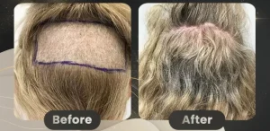 Women Hair Transplant Before and after