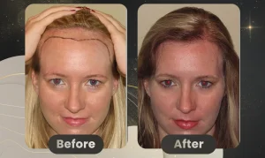 women Hair Restoration before and after