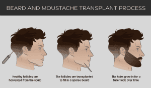 How is Beard Transplant-Performed