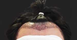 Women Hair Transplante Without Shaving