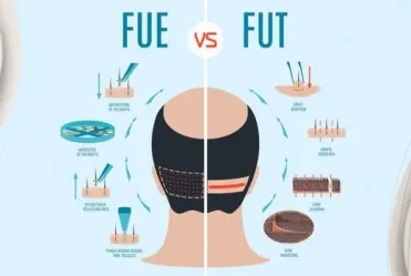 Latest Hair Transplant Techniques: FUE Vs FUT