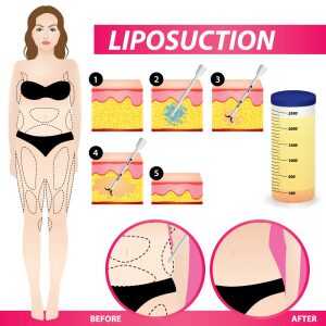 Liposuction Surgery before and after