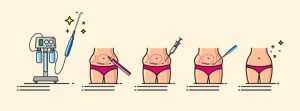 Areas for Liposuction