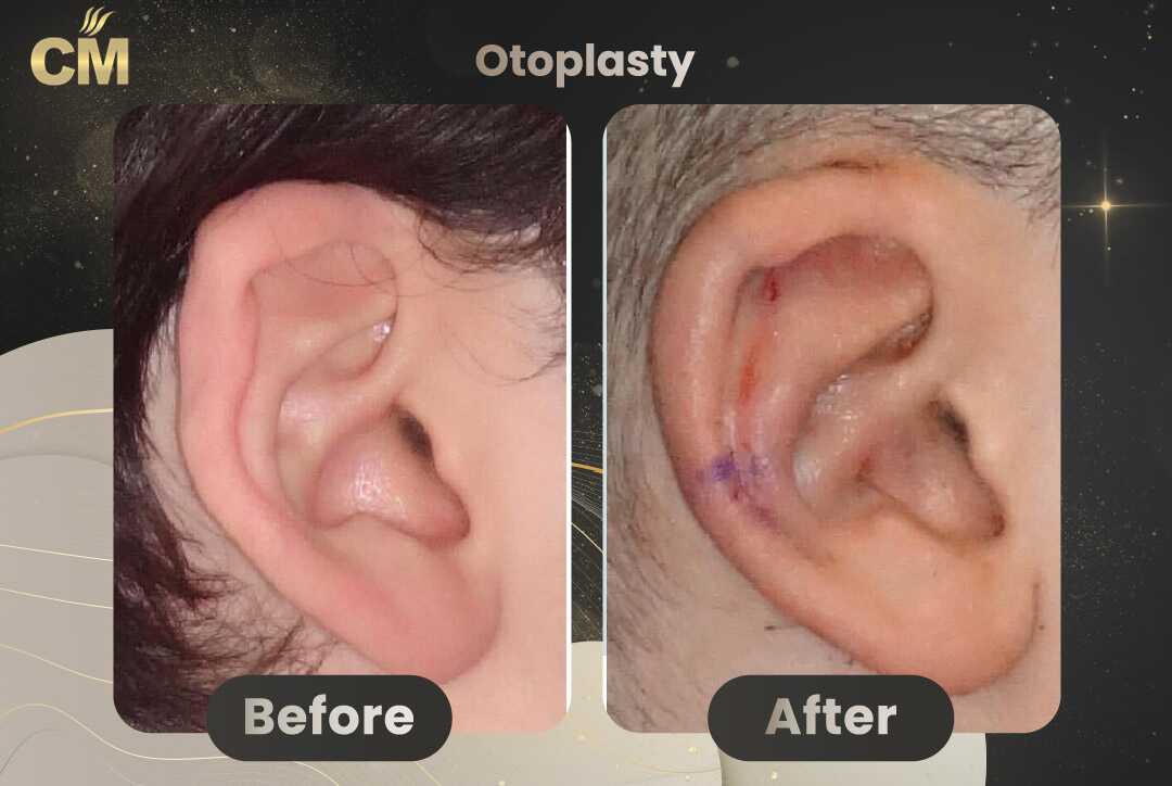 Otoplasty (Ear Surgery) Before After in Turkey