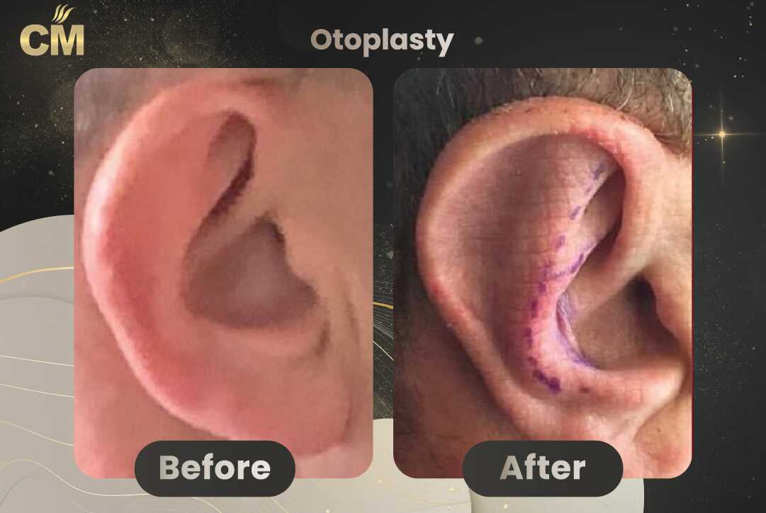 Otoplasty (Ear Surgery) Before After in Turkey