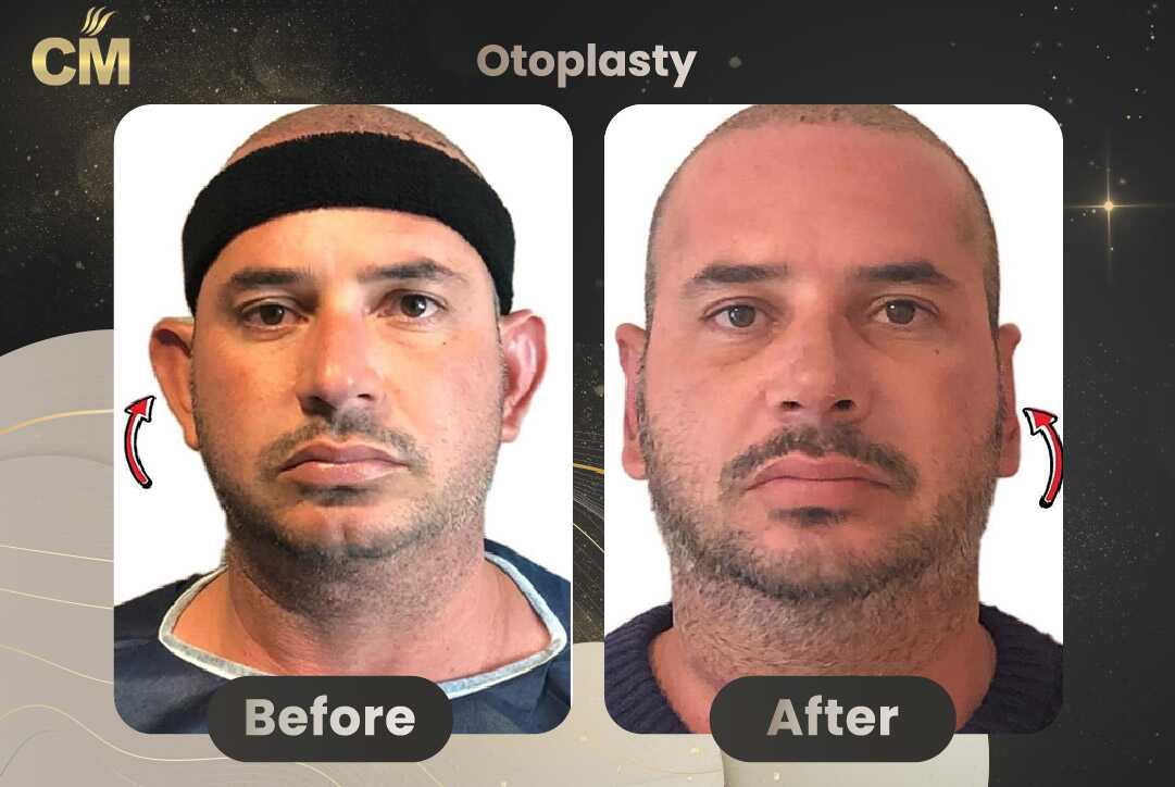 Otoplasty (Ear Surgery) Before After in Turkey