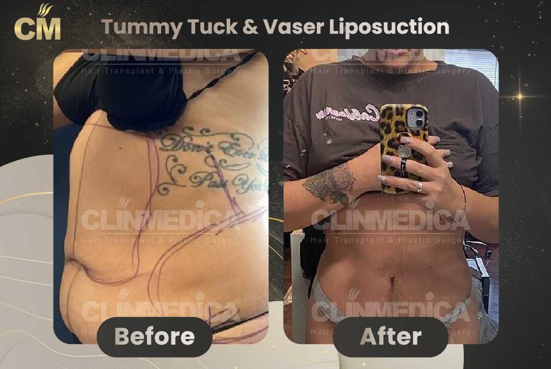 Tummy Tuck (Abdominoplasty) Before and After in Turkey