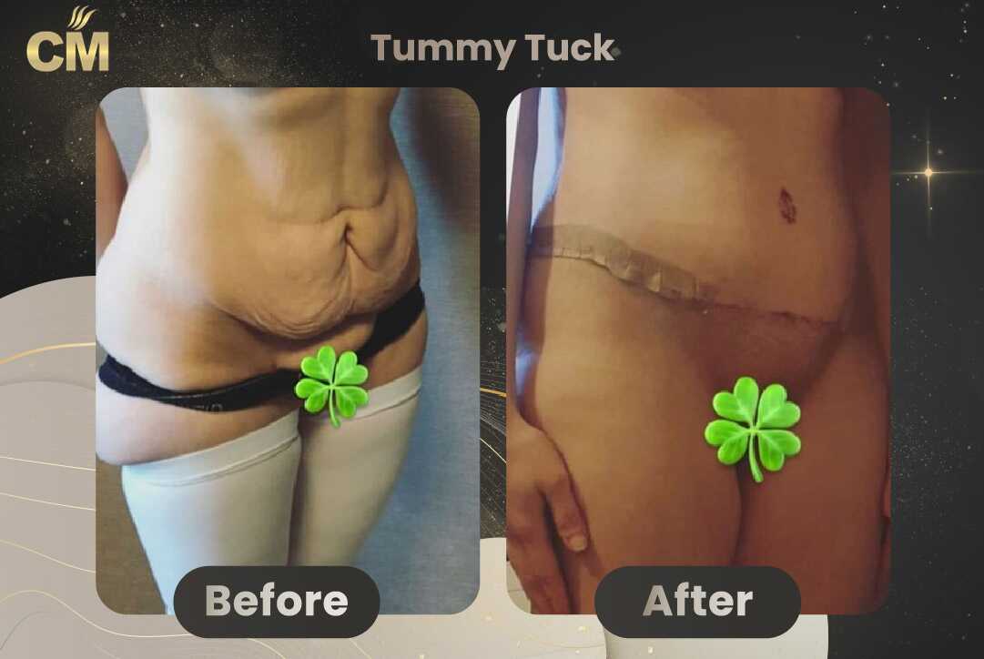 Tummy Tuck (Abdominoplasty) Before and After in Turkey