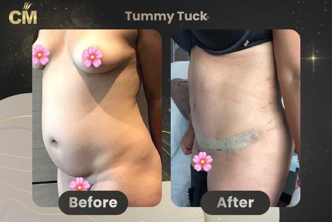 Tummy Tuck (Abdominoplasty) Before and After in Turkey