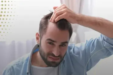 When to Get a Hair Transplant?