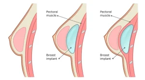 breast implant placements