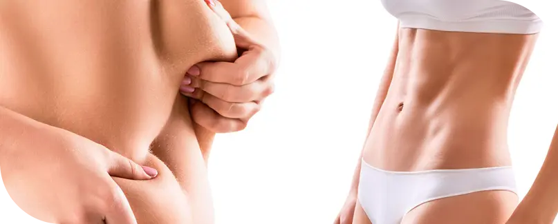 Liposuction Surgery in Turkey