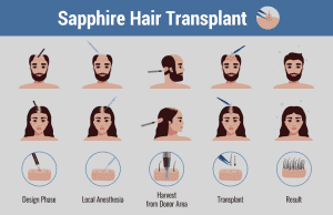 sapphire ​​pen technique for hair transplantation