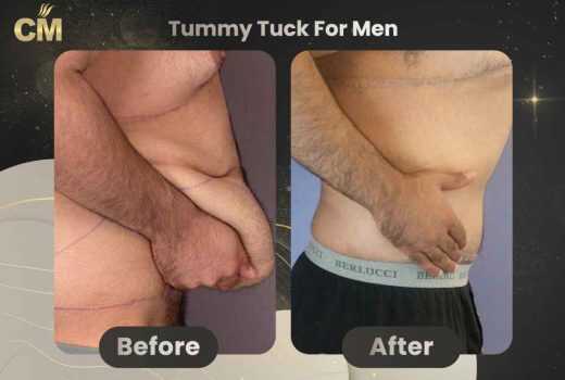 Tummy Tuck For Men Before and After in Turkey