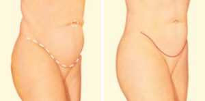 tummy tuck side before after