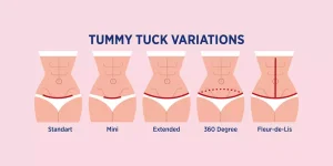 Types of Tummy Tuck Procedures - abdominoplasty in Turkey